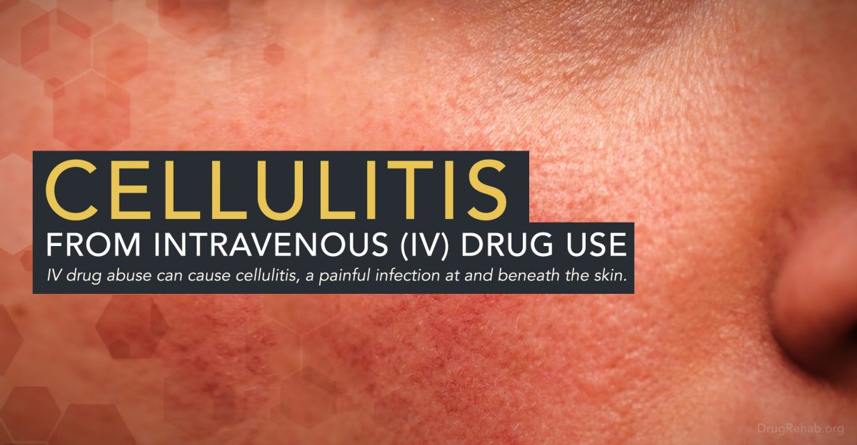 Cellulitis_