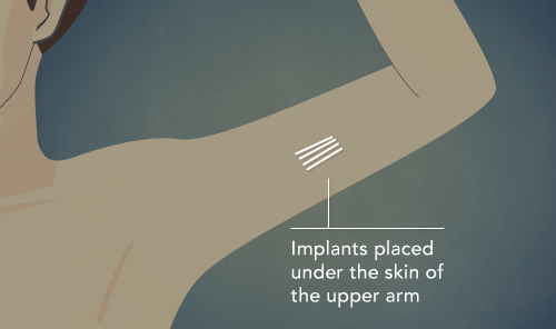 Implant May Spur Recovery from Opioid Addiction