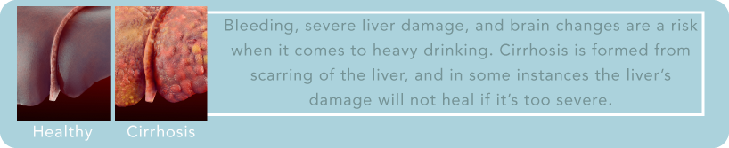 DrugRehab.org What Does Alcohol Do to Your Liver_ Cirrhosis