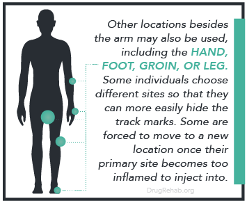 DrugRehab.org What Are Track Marks-Injection Locations